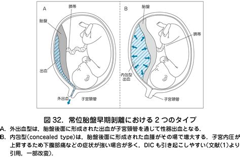 胎盤剝離後期|常位胎盤早期剥離